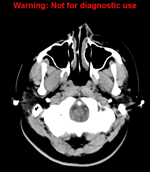 File:Cerebral venous thrombosis (Radiopaedia 37224-38992 Axial non-contrast 3).jpg