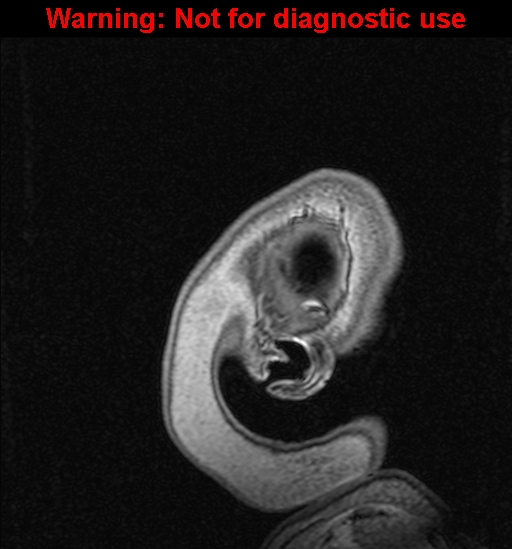 Cerebral venous thrombosis (Radiopaedia 37224-39208 Sagittal T1 C+ 150).jpg