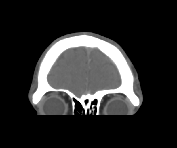 Cerebral venous thrombosis (Radiopaedia 38392-40467 Coronal CTA-Venogram 10).png