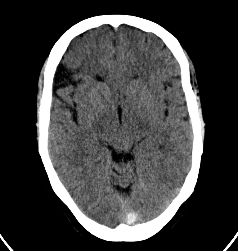 Cerebral venous thrombosis - CT only (Radiopaedia 41031-43778 Axial non-contrast 48).jpg
