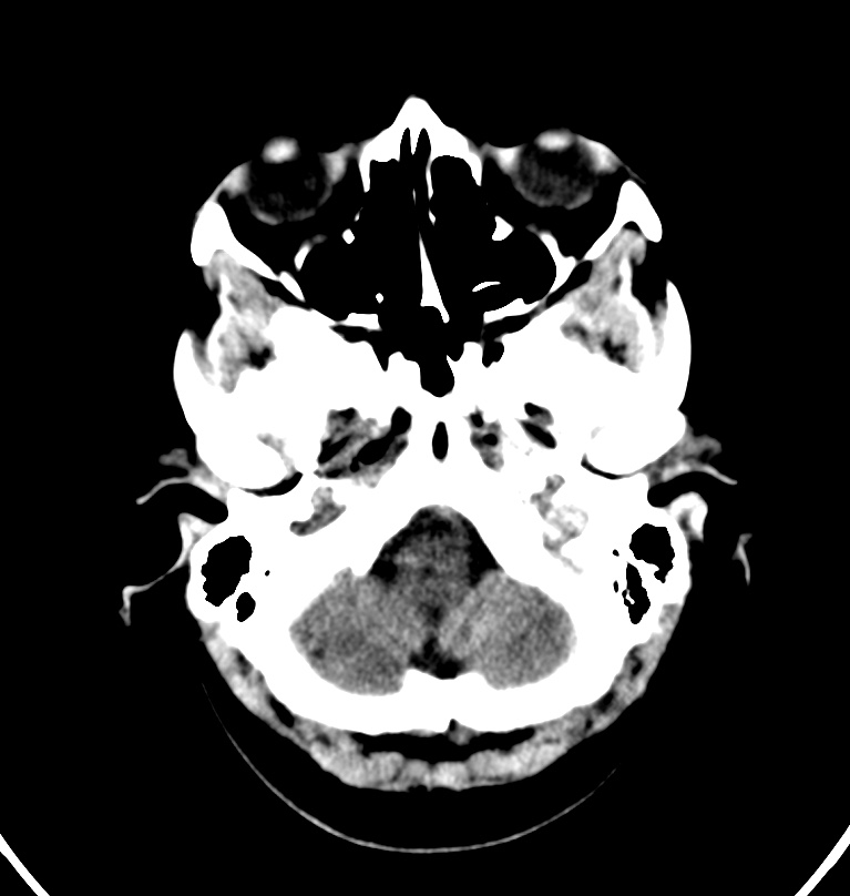 Cerebral venous thrombosis - CT only (Radiopaedia 41031-43778 Axial non-contrast 76).jpg