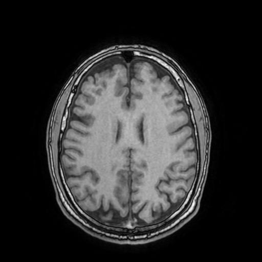 Cerebral venous thrombosis with secondary intracranial hypertension (Radiopaedia 89842-106957 Axial T1 116).jpg