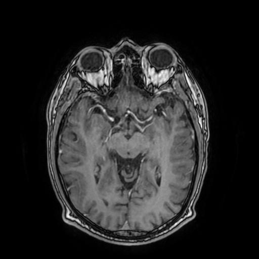 File:Cerebral venous thrombosis with secondary intracranial hypertension (Radiopaedia 89842-106957 Axial T1 C+ 85).jpg