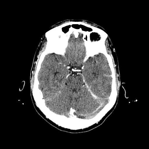 File:Cerebral venous thrombosis with venous hemorrhagic infarct (Radiopaedia 90354-107660 Axial with contrast 60).jpg