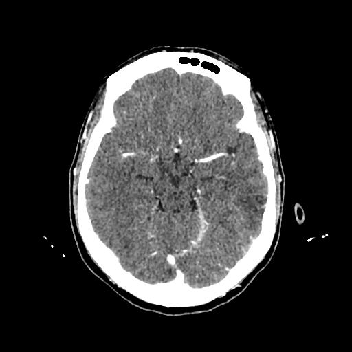 Cerebral venous thrombosis with venous hemorrhagic infarct (Radiopaedia 90354-107660 Axial with contrast 67).jpg