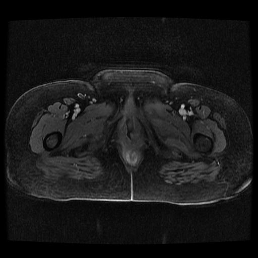 Cervical carcinoma (Radiopaedia 70924-81132 Axial T1 C+ fat sat 106).jpg