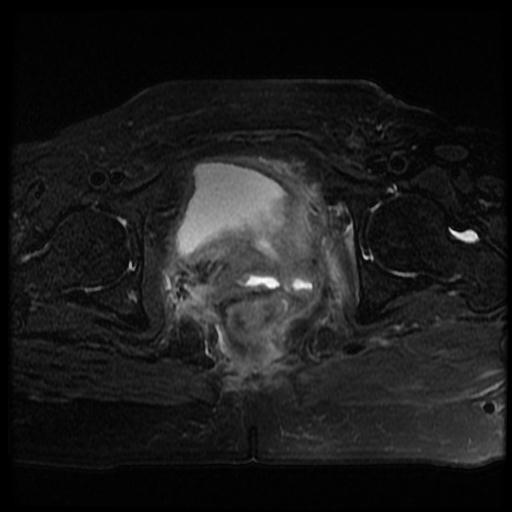 File:Cervical carcinoma (Radiopaedia 70924-81132 Axial T2 fat sat 13).jpg