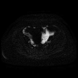 Cervical carcinoma (Radiopaedia 85405-101028 Axial DWI 35).jpg