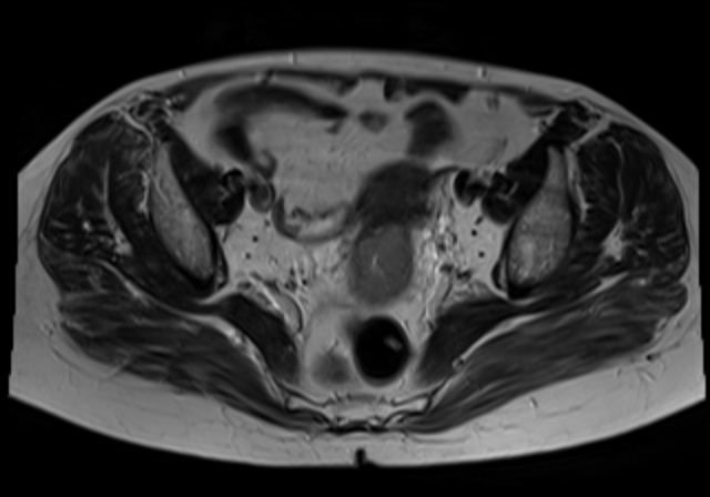 File:Cervical carcinoma (Radiopaedia 88312-104943 Sagittal T1 11).jpg
