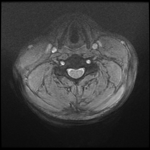 Cervical disc extrusion (Radiopaedia 59074-66364 F 24).jpg