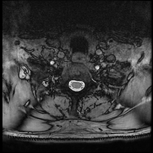 Cervical disc extrusion (Radiopaedia 59074-66364 G 91).jpg