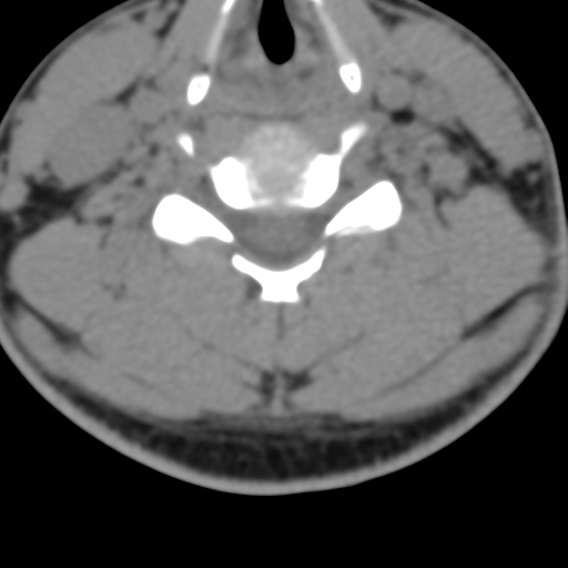 Cervical schwannoma (Radiopaedia 57979-64974 Axial non-contrast 40).png