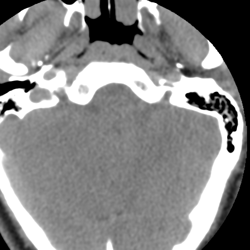 Cervical schwannoma (Radiopaedia 57979-64974 Axial non-contrast 6).png