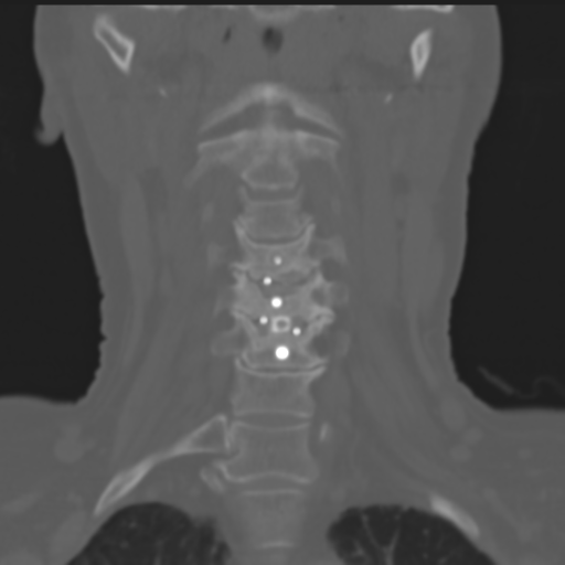 Cervical spine ACDF loosening (Radiopaedia 48998-54071 Axial bone window 1).png
