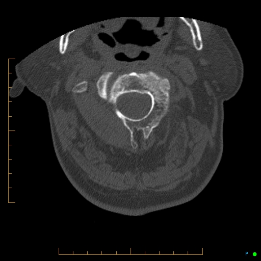Cervical spine fracture - ankylosing spondylitis (Radiopaedia 76835-88706 Axial bone window 49).jpg