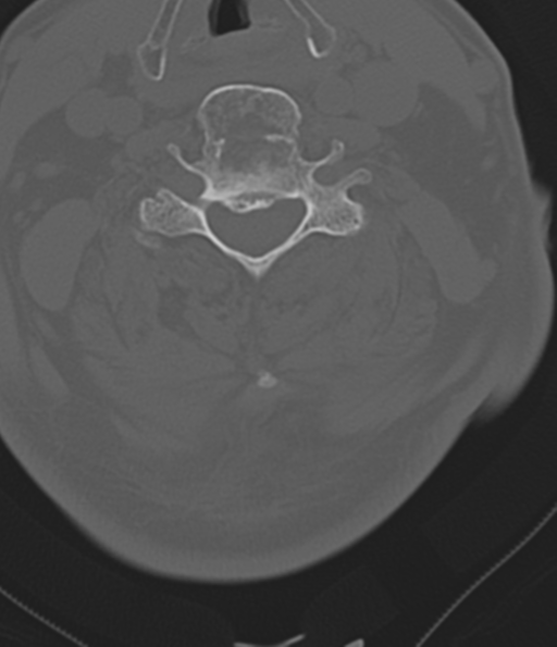 File:Cervical spine fracture in the setting of ankylosis (Radiopaedia 37038-38715 Axial bone window 34).png