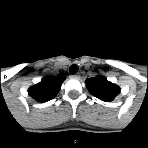 File:Cervical thymic cyst (Radiopaedia 88632-105335 Axial non-contrast 30).jpg
