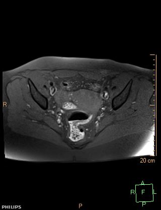 File:Cesarian scar endometriosis (Radiopaedia 68495-78066 Axial T1 fat sat 12).jpg