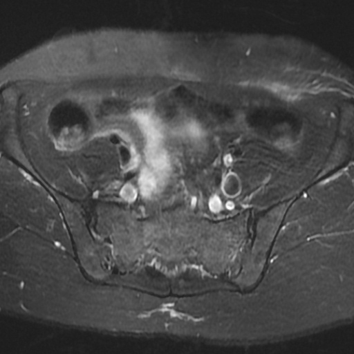 File:Cesarian section scar endometriosis (Radiopaedia 66520-75799 Axial T2 fat sat 3).jpg