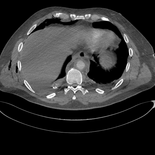 File:Chest multitrauma - aortic injury (Radiopaedia 34708-36147 A 233).png