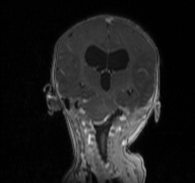 Chiari III malformation with occipital encephalocele (Radiopaedia 79446-92559 Coronal T1 C+ mpr 21).jpg