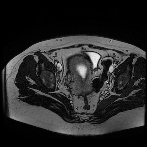 Chiari II malformation - fetal MRI (Radiopaedia 68099-77581 Axial Fiesta 54).jpg