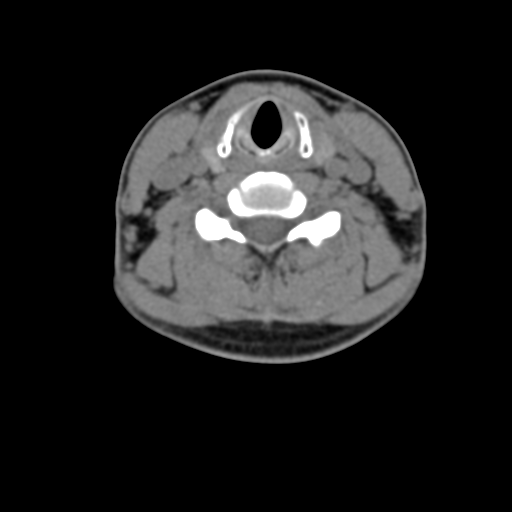 Chiari I malformation and obstructive hydrocephalus (Radiopaedia 41185-43981 D 61).png