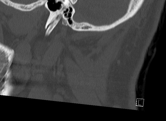 Chiari I malformation with a symptomatic syrinx of the posterolateral medulla oblongata (Radiopaedia 42573-45707 A 52).jpg