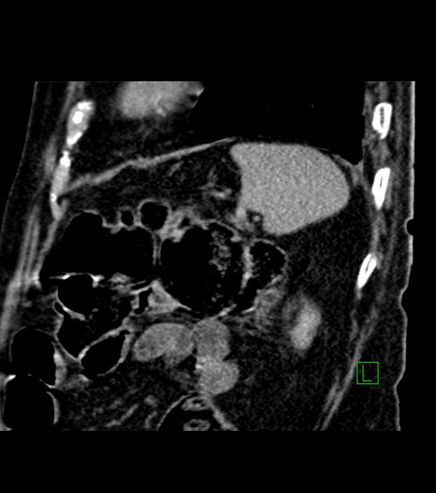 Cholangiocarcinoma with cerebral metastases (Radiopaedia 83519-98629 Sagittal C+ delayed 24).jpg