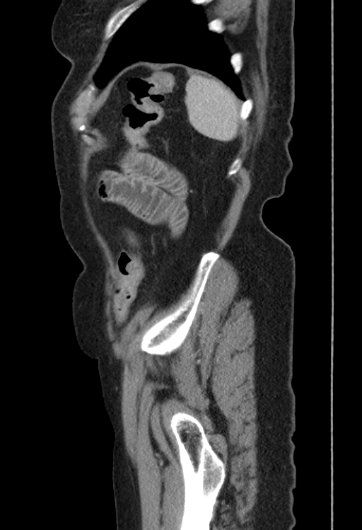Cholecystoduodenal fistula due to calculous cholecystitis with gallstone migration (Radiopaedia 86875-103077 F 6).jpg