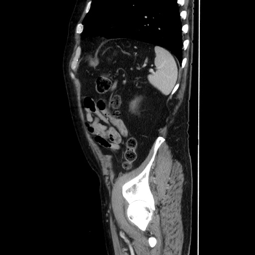 Choledocholiathiasis with normal caliber common bile duct (Radiopaedia 75368-86632 D 124).jpg
