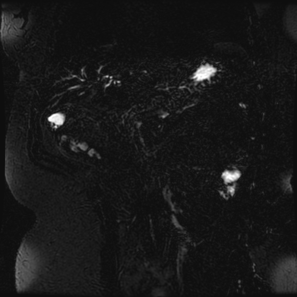 Choledocholithiasis on CT and MRI (Radiopaedia 24825-25088 Coronal T2 72).jpg