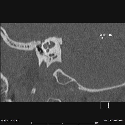 Cholesteatoma - external auditory canal (Radiopaedia 88452-105096 Sagittal bone window 52).jpg