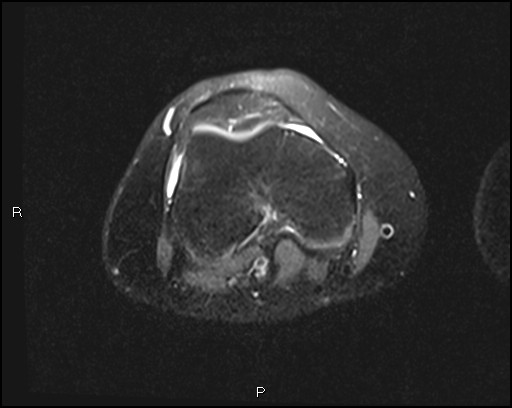 File:Chondroblastoma (Radiopaedia 62721-71031 Axial PD fat sat 15).jpg