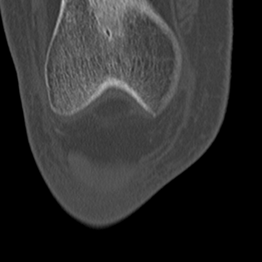 Chondrocalcinosis (Radiopaedia 16275-15955 Coronal bone window 15).jpg