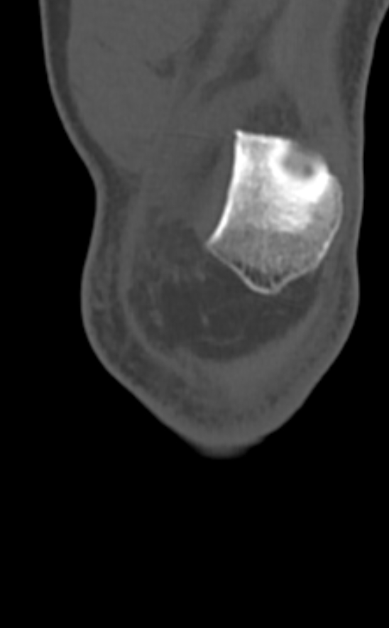 Chondrocalcinosis (Radiopaedia 82862-97173 Coronal bone window 15).jpg