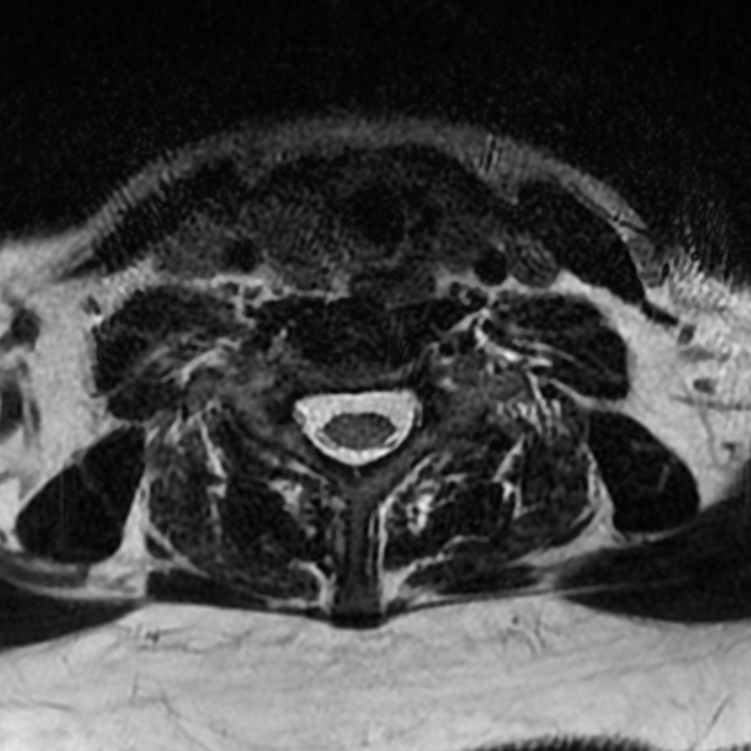 Chordoma - cervical spine (Radiopaedia 70084-80111 Axial T2 70).png