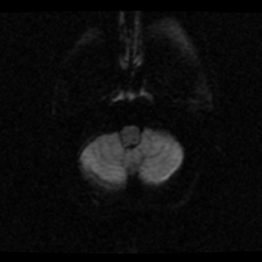 File:Choroid plexus xanthogranuloma (Radiopaedia 17650-17386 DWI 21).jpg