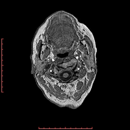 Choroid plexus xanthogranuloma (Radiopaedia 67843-77270 Axial T1 164).jpg