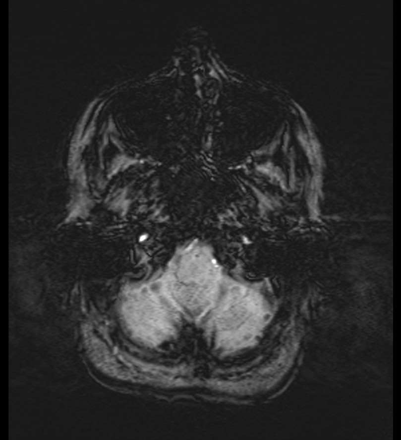 Choroid plexus xanthogranuloma (Radiopaedia 91271-108875 Axial SWI 10).jpg