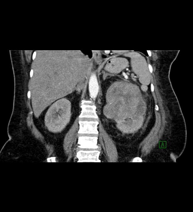 Chromophobe renal cell carcinoma (Radiopaedia 84239-99519 C 57).jpg
