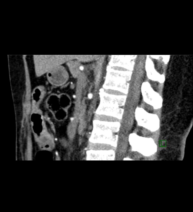 Chromophobe renal cell carcinoma (Radiopaedia 84290-99582 D 49).jpg