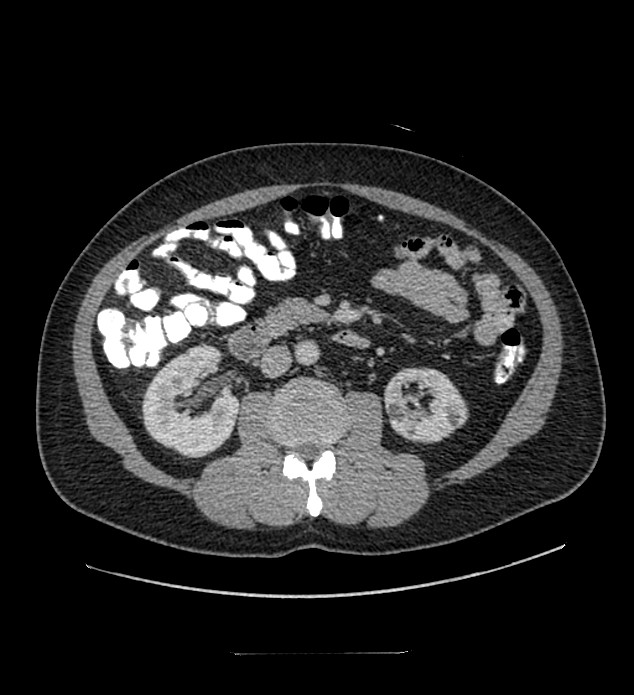 Chromophobe renal cell carcinoma (Radiopaedia 84337-99644 C 61).jpg