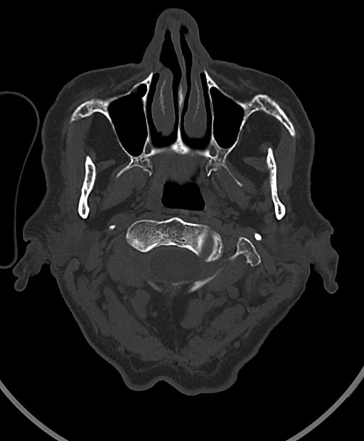 Chronic bilateral subdural hygroma (Radiopaedia 85801-101623 Axial bone window 117).jpg