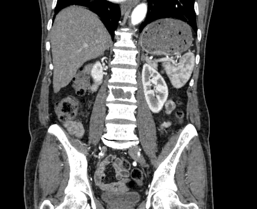 Chronic contained rupture of abdominal aortic aneurysm with extensive erosion of the vertebral bodies (Radiopaedia 55450-61901 D 49).jpg