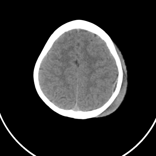 File:Chronic extradural hemorrhage (Radiopaedia 43221-46531 Axial non-contrast 12).jpg