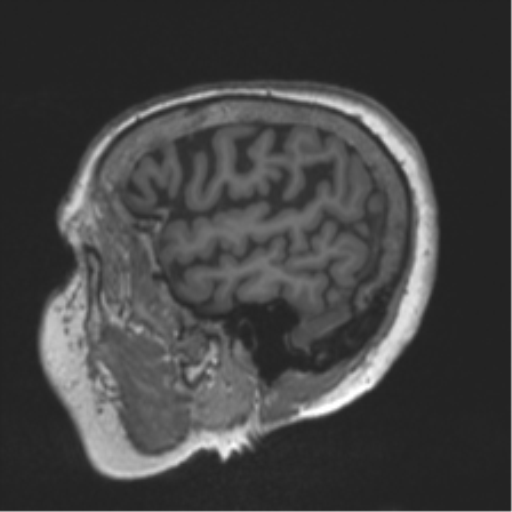 Chronic hypertensive encephalopathy (Radiopaedia 39993-42482 Sagittal T1 20).png