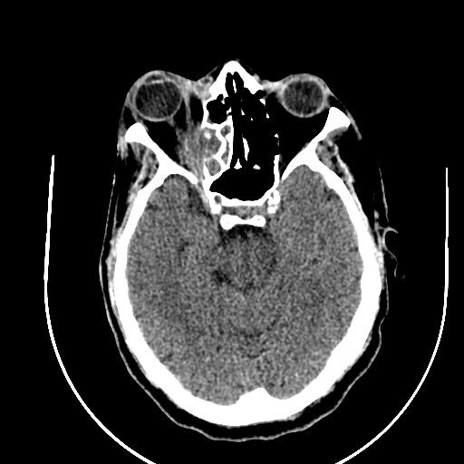 Chronic invasive fungal sinusitis (Radiopaedia 91563-109286 Axial non-contrast 36).jpg