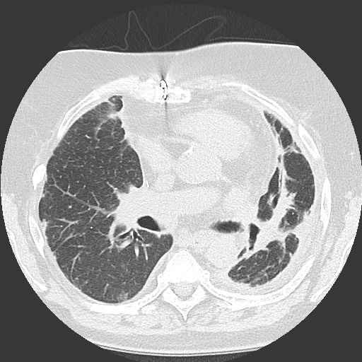 Chronic lung allograft dysfunction - restrictive form (Radiopaedia 60595-68316 Axial lung window 33).jpg