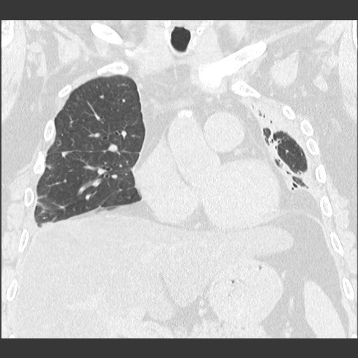 Chronic lung allograft dysfunction - restrictive form (Radiopaedia 60595-68316 Coronal lung window 46).jpg